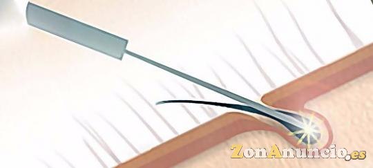 CURSO DE ELECTROLISIS O DEPILACION ELECTRICA