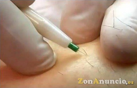 CURSO DE ELECTROLISIS O DEPILACION ELECTRICA